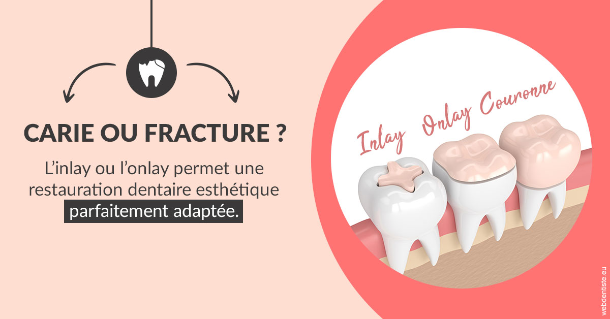https://dr-manhes-luc.chirurgiens-dentistes.fr/T2 2023 - Carie ou fracture 2
