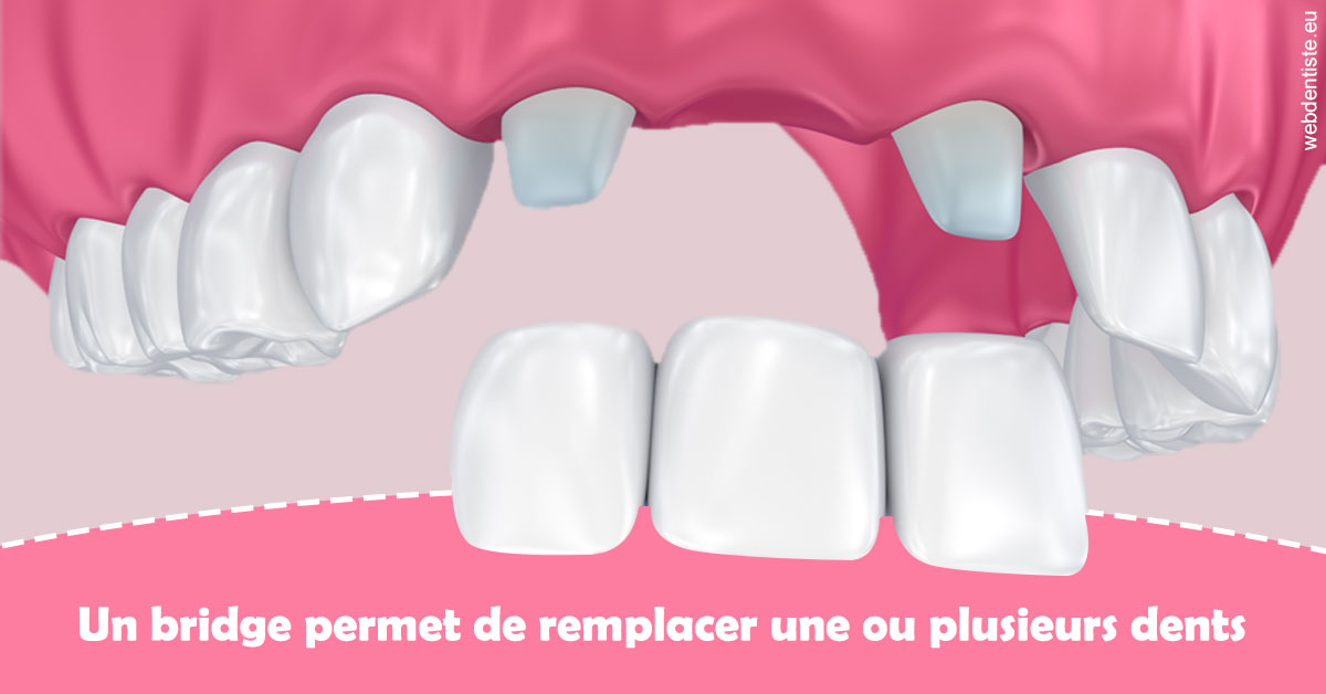 https://dr-manhes-luc.chirurgiens-dentistes.fr/Bridge remplacer dents 2