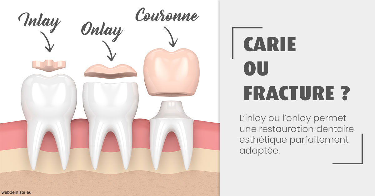 https://dr-manhes-luc.chirurgiens-dentistes.fr/T2 2023 - Carie ou fracture 1