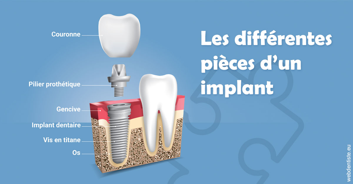 https://dr-manhes-luc.chirurgiens-dentistes.fr/Les différentes pièces d’un implant 1