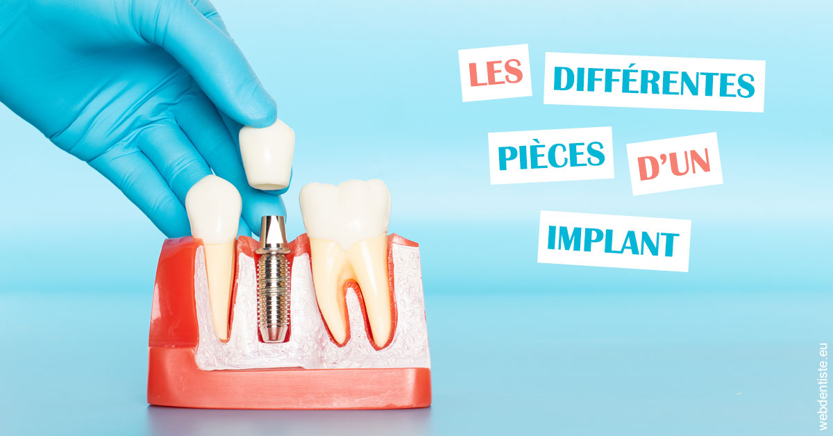 https://dr-manhes-luc.chirurgiens-dentistes.fr/Les différentes pièces d’un implant 2